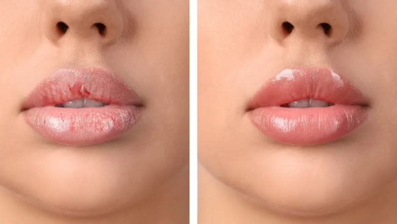 Lip Pigmentation Treatment in Bangalore – Get Even-Toned, Beautiful Lips