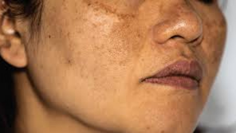 How Long Does It Take to Fade Hyperpigmentation on Asian Skin?