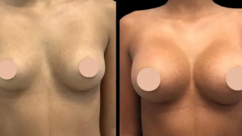 Breast Augmentation Recovery Expert Tips from the Best Breast Augmentation Surgeon in Dubai