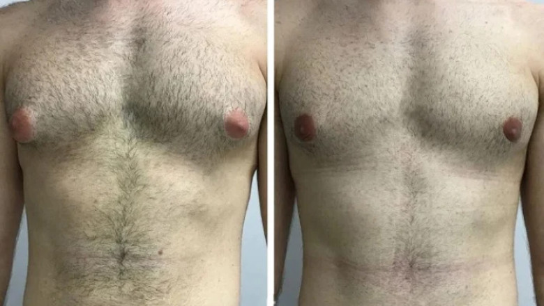 Comparing Clinics to Find the Best Gynecomastia Surgeon in Dubai