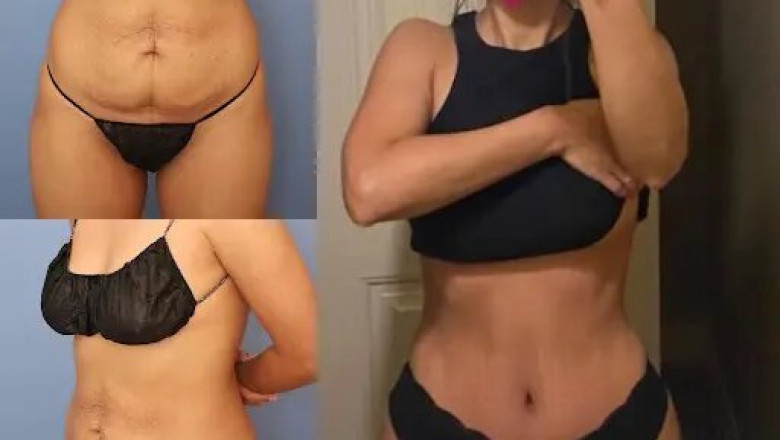 How to Evaluate the Best Tummy Tuck Surgeon in dubai