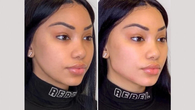 Top Reasons the Best Plastic Surgeon in Dubai Recommends Thread Lifts for Non-Surgical Rejuvenation