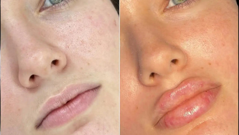 How to Ensure Long-Lasting Results with Russian Lip Fillers Treatment in Dubai