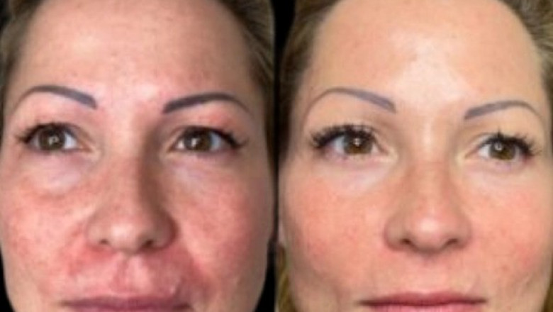 Who Can Benefit from Profhilo Treatment in Dubai Ideal Candidates and Results