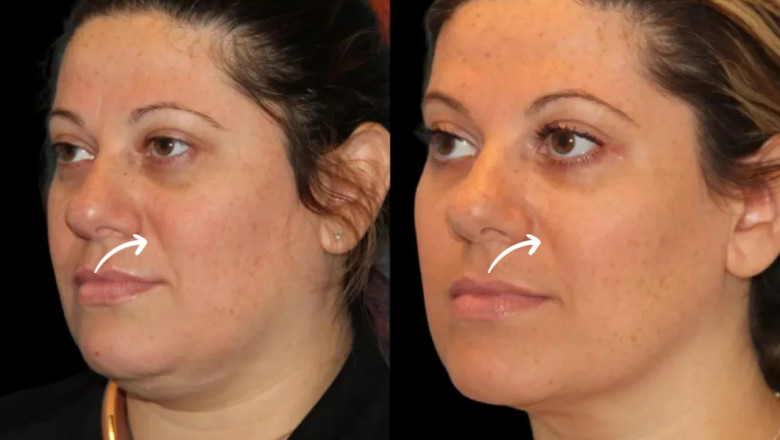 Best Aesthetic Clinics in Dubai for Sculptra Fillers Nasolabial Fold Correction