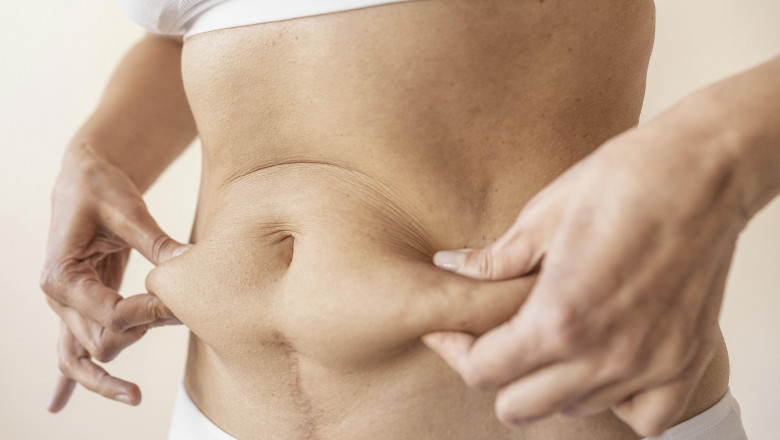 Your Liposuction Journey Insights from Best Liposuction Surgeons in Dubai