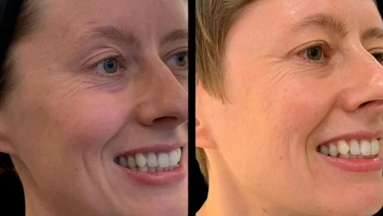 Top 5 Reasons to Choose Profhilo Treatment in Dubai Over Other Fillers