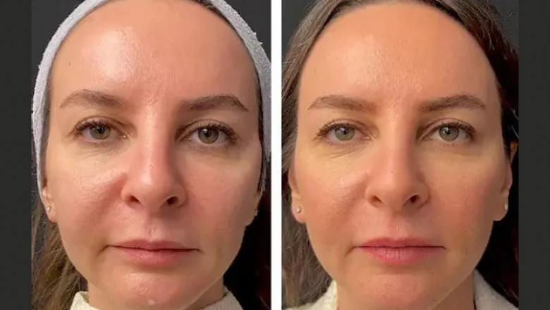 Best Doctors in Dubai Reveal the Dos and Don’ts Before Mesotherapy