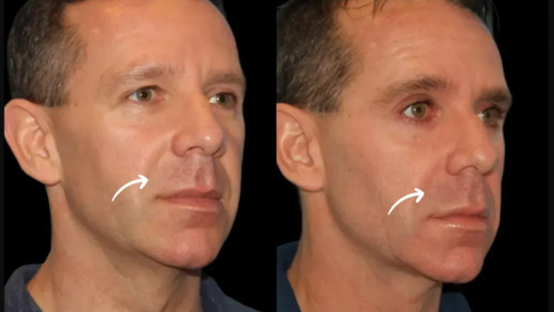 FAQs on Sculptra Fillers Answered by the Best Doctors in Dubai