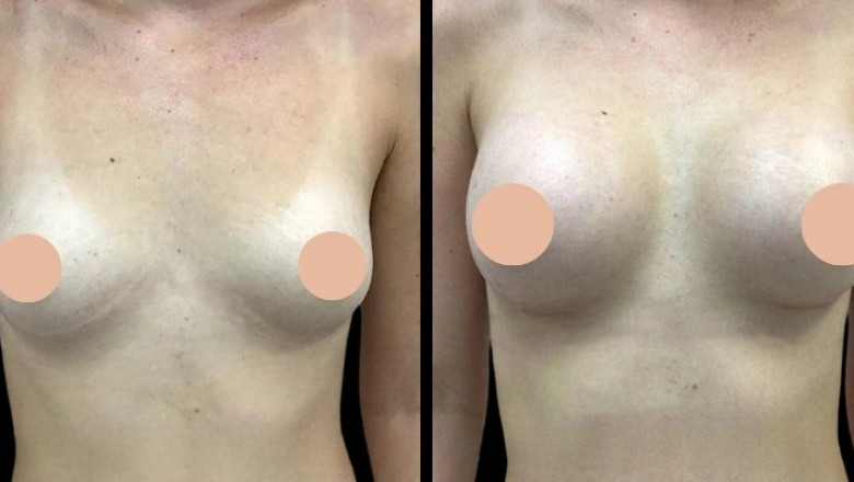 Breast Augmentation Surgery in Dubai: Understanding the Different Incision Techniques and Their Benefits