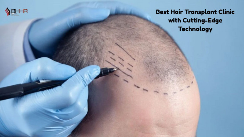 Best Hair Transplant Clinic with Cutting-Edge Technology