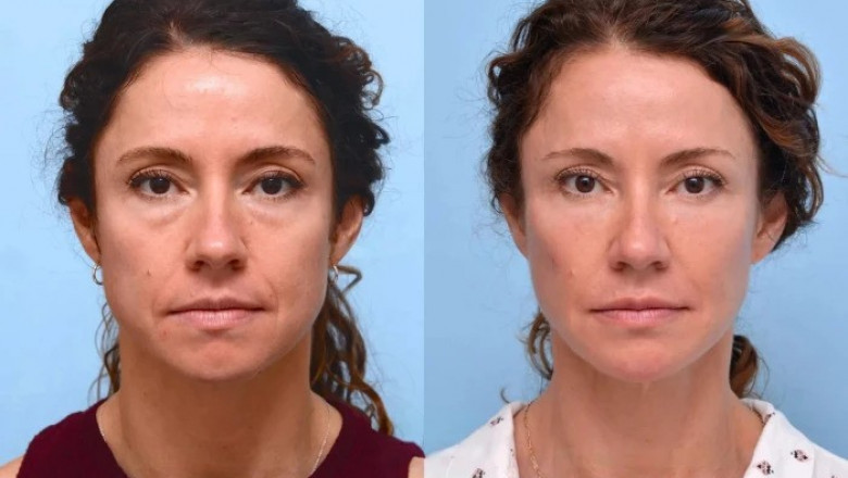 Why the Best Plastic Surgeons in Dubai Recommend Thread Lifts for Natural Results