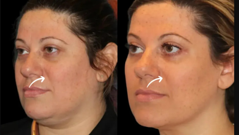 Why Fitness Enthusiasts Choose Sculptra Fillers from the Best Plastic Surgeon in Dubai