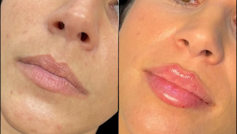 Best Doctors in Dubai for Fillers: Experience You Can Trust