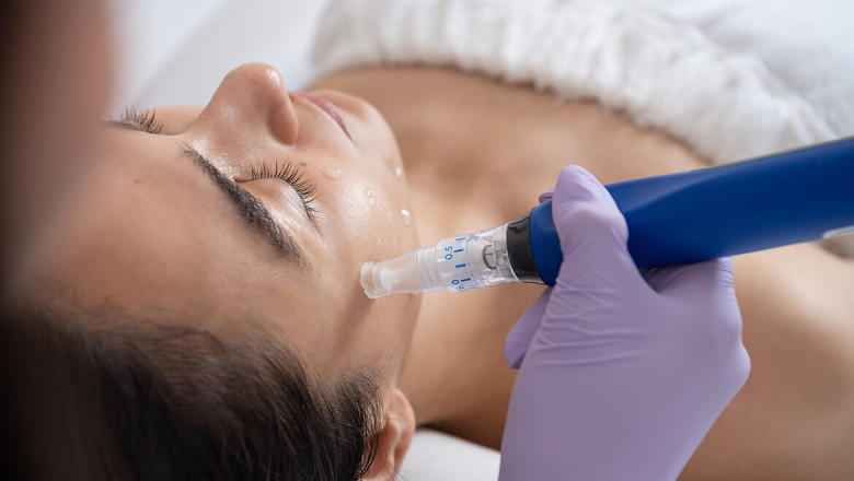 Microneedling for Acne Scars in Ilford: Real Results, Real People