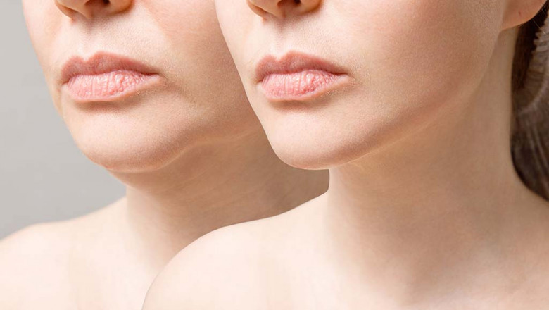 Consider Fillers Instead of Surgery