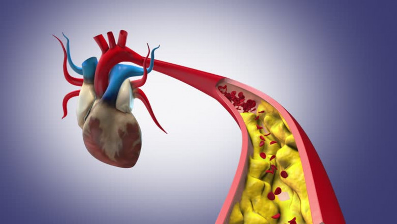 Top 4 Types of Heart Disease That Could Affect Your Life—Know the Signs