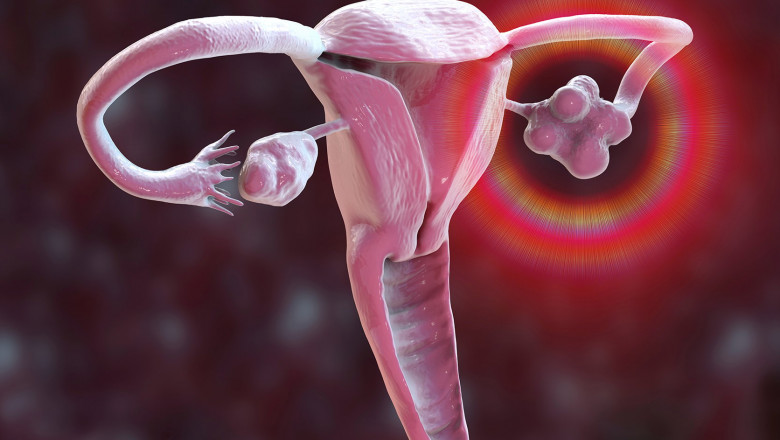 Why Bangalore is Emerging as a Hub for Advanced PCOS Treatment