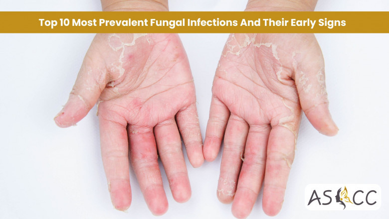 Top 10 Most Prevalent Fungal Infections And Their Early Signs