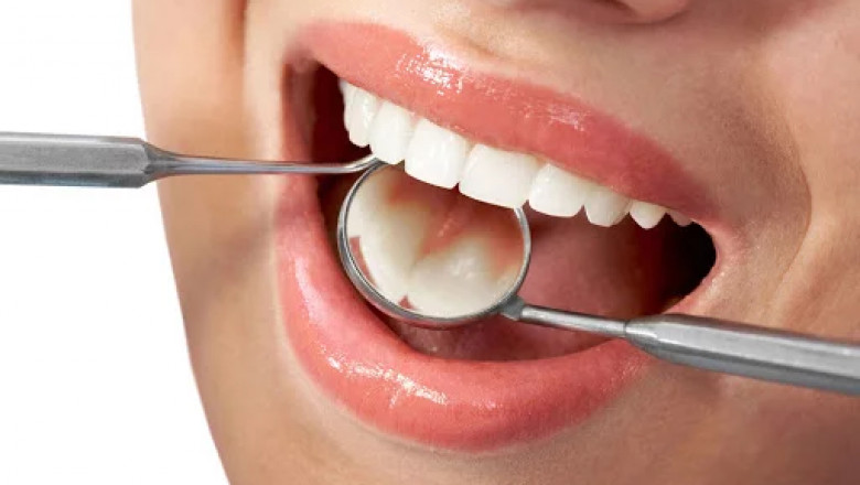 Top Benefits of Getting a Tooth Crown Dubai for Damaged Teeth