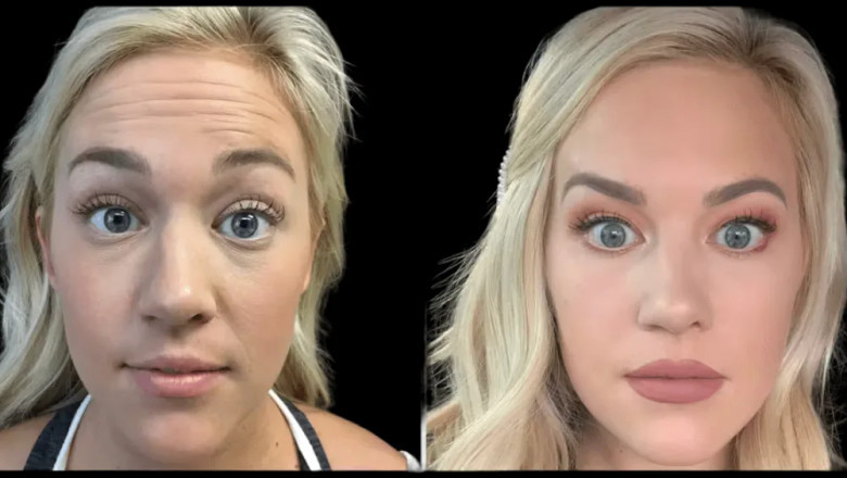 Expert Botox Tips for Long-Lasting Results from the Best Plastic Surgeon in dubai