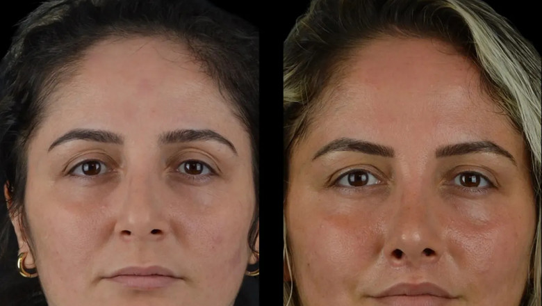 What Is the Recovery Time for Cheek Fillers Treatment in Dubai?