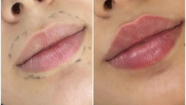 Juvederm for a Smooth and Youthful Appearance: Why the Best Aesthetic Clinic in dubai Is the Top Choice