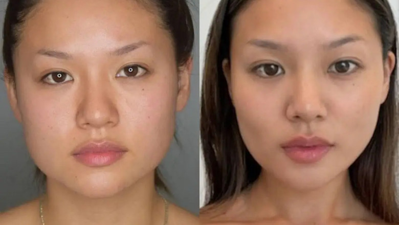 My Journey to a Slimmer Face with the Best Buccal fat removal Surgeons in dubai