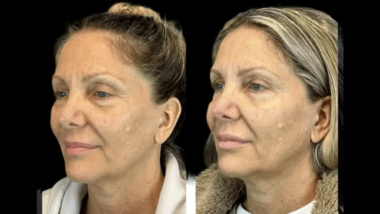 Safety First: How to Choose a Trusted Provider for Botox in Dubai