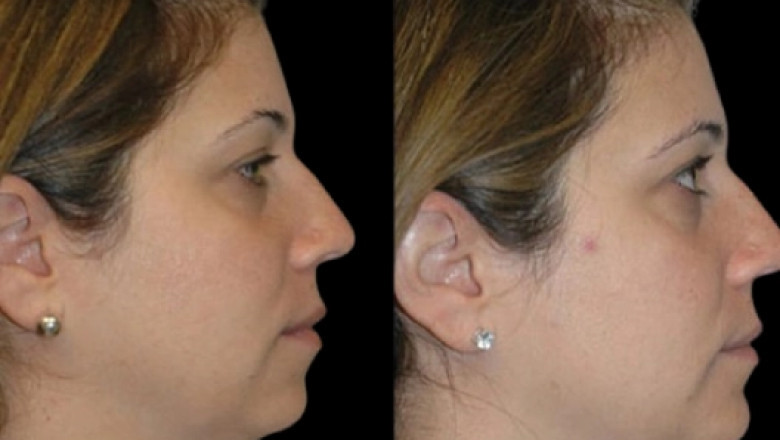The Best Double chin removal Surgeons in dubai: What Makes Them Experts?