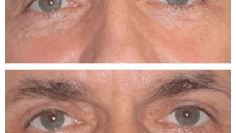The Best Eye bag removal Surgeons in dubai: Your Guide to Smooth Recovery