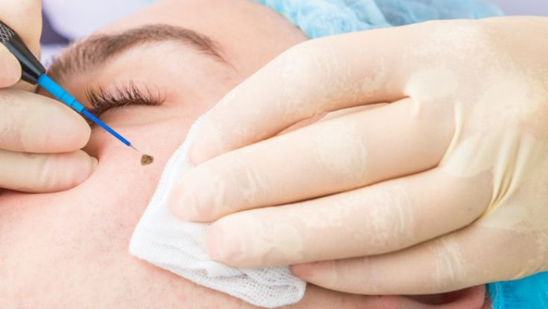 Mole Check Dubai: A Complete Guide to Skin Health and Early Detection