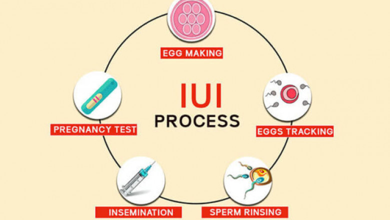 iui treatment cost in Delhi - Dr Rhythm Gupta