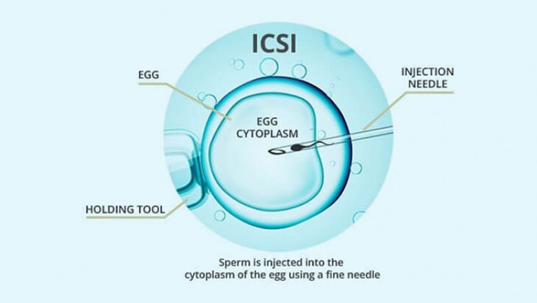 icsi treatment in Delhi - Dr Rhythm Gupta