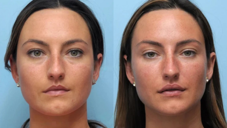 Real Results with Thread Lift Treatment in Dubai