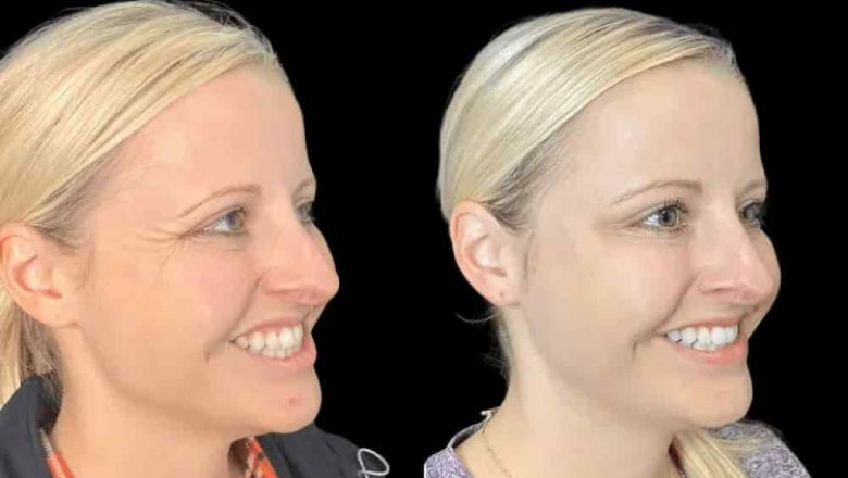 What to Expect from Your Botox Treatment in Dubai